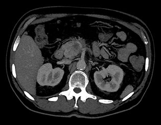 Traditional CT Scan Result