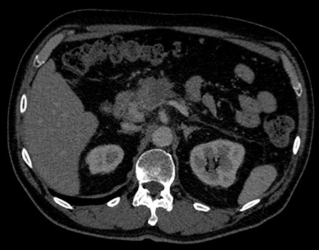 Traditional CT Scan Result