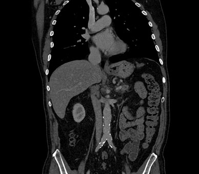 Traditional CT body scan